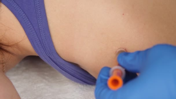 Os médicos mãos em luvas médicas colocar uma sanguessuga com uma seringa na cicatriz no ombro close-up. — Vídeo de Stock