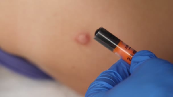 Os médicos mãos em luvas médicas segurar uma seringa com um close-up sanguessuga. O procedimento para reduzir as cicatrizes. — Vídeo de Stock