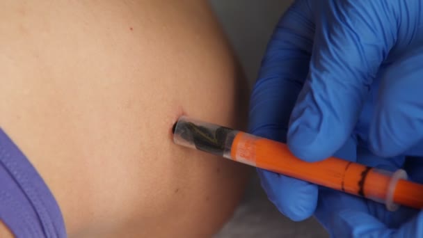 Une main de médecin dans un gant médical met une sangsue avec une seringue sur la cicatrice sur l'épaule gros plan. La sangsue colle à la peau des patients. — Video