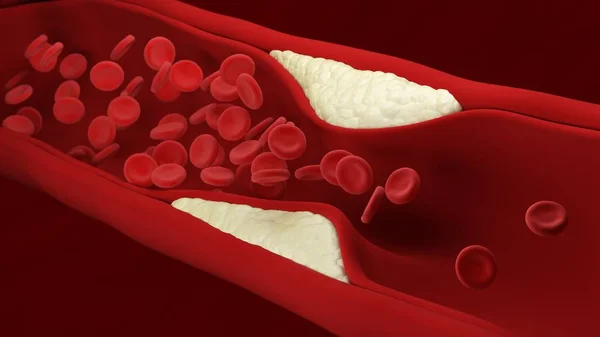 Aterosclerosi Placca Accumula All Interno Arteria Cellule Del Sangue Illustrazione — Foto Stock