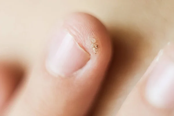 Verruga, papiloma en un dedo de niño. Tiro macro, enfoque selectivo, primer plano, espacio para el texto. Problemas dermatológicos de la piel — Foto de Stock