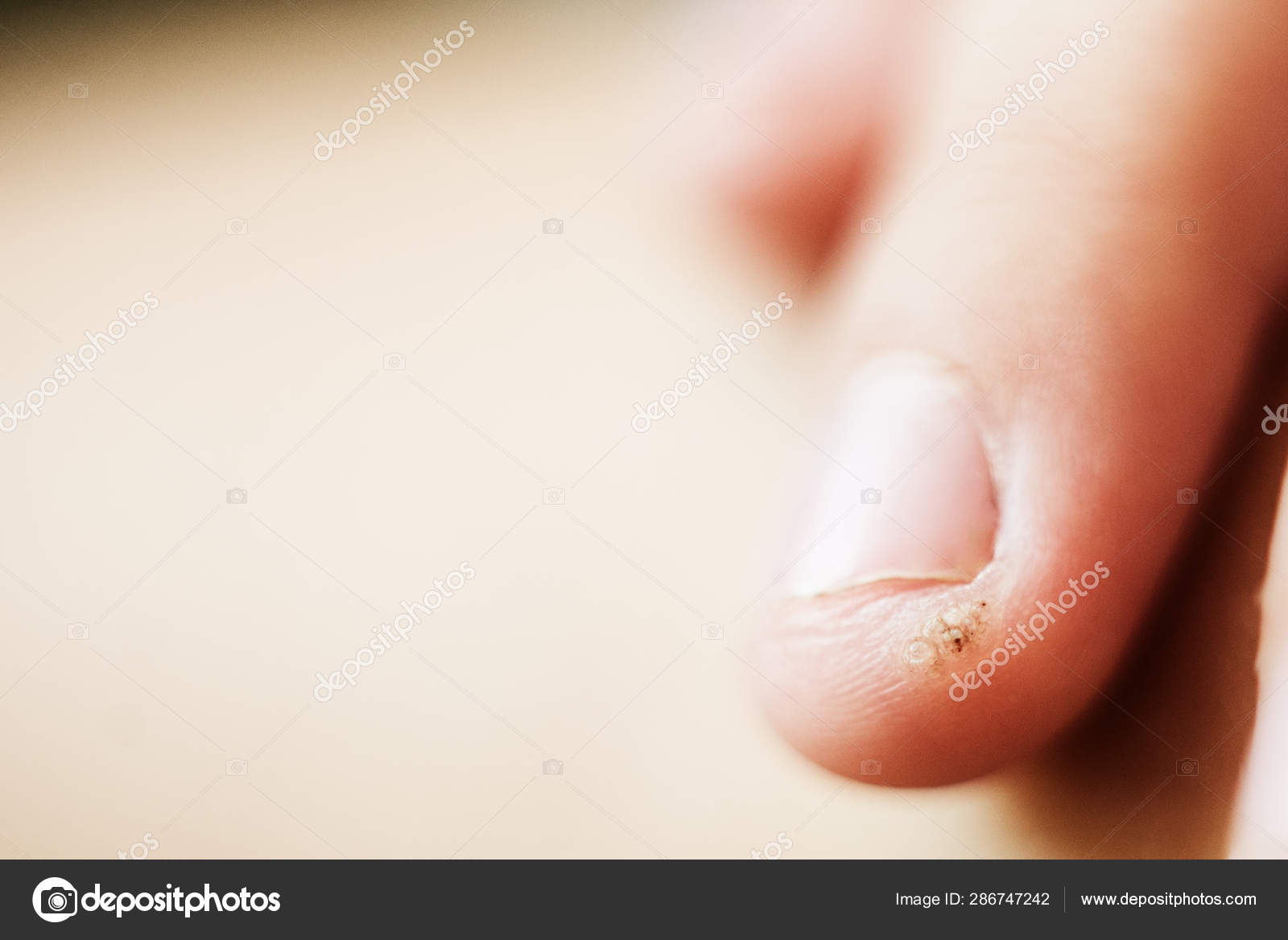 pirított barna gomba amely a papillomatosis és a hyperkeratosis