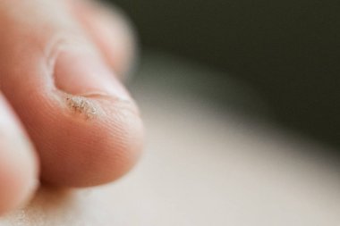 bir çocuğun parmağında siğil, papilloma. Makro çekim, seçici odaklama, yakın çekim, metin alanı. Deri ile dermatolojik sorunlar