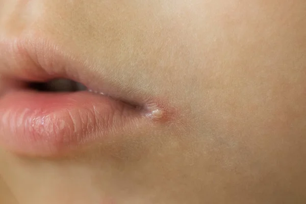 Huidproblemen, angulitis, hoek stomatitis, hoekige Cheilitis een ziekte van het slijmvlies en de huid van de hoeken van de mond, veroorzaakt door streptokokken — Stockfoto