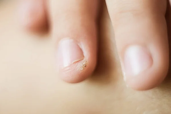 Wart, papilloma on a childs finger. Macro shot, selective focus, close-up, space for text. Dermatological problems with the skin — Stock Photo, Image