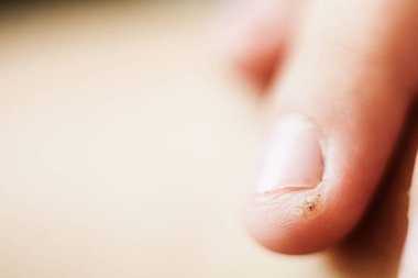 bir çocuğun parmağında siğil, papilloma. Makro çekim, seçici odaklama, yakın çekim, metin alanı. Deri ile dermatolojik sorunlar
