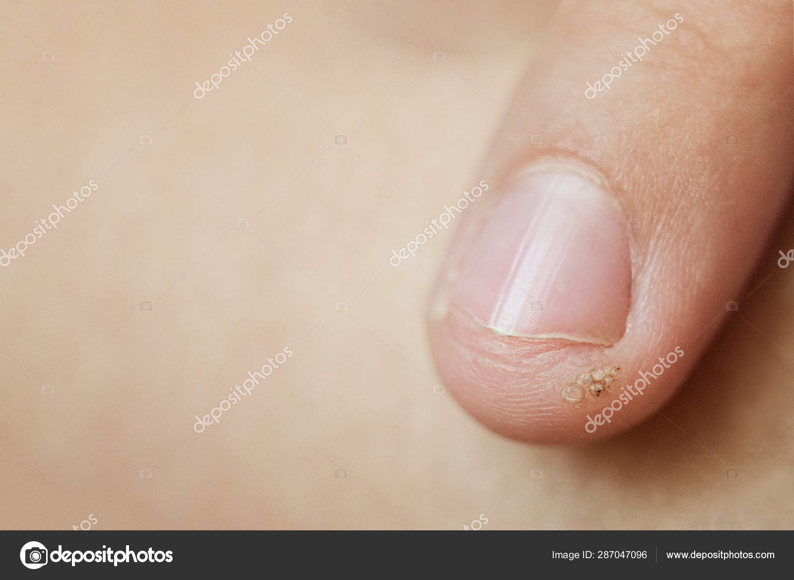 papilloma on finger cum să scapi de larvele de vierme
