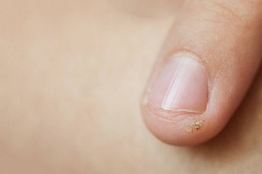 bir çocuğun parmağında siğil, papilloma. Makro çekim, seçici odaklama, yakın çekim, metin alanı. Deri ile dermatolojik sorunlar