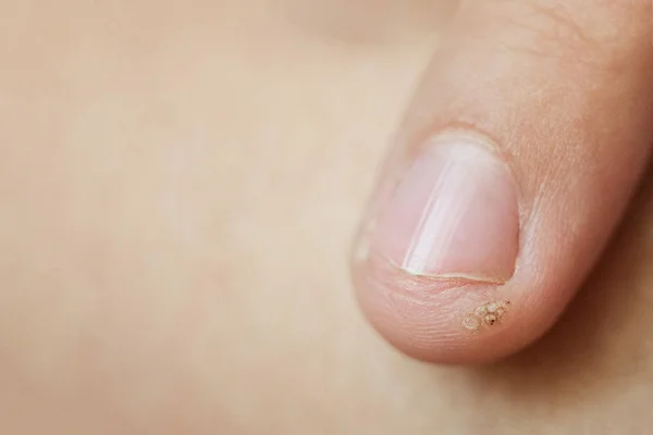 いぼ、小児指の乳頭腫。マクロショット、選択的フォーカス、クローズアップ、テキスト用のスペース。皮膚の皮膚科学的な問題 — ストック写真