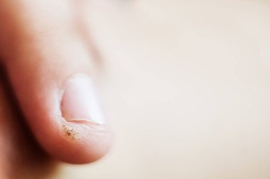 bir çocuğun parmağında siğil, papilloma. Makro çekim, seçici odaklama, yakın çekim, metin alanı. Deri ile dermatolojik sorunlar