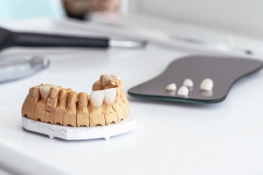 Artificial jaw with dental veneers and crowns in the office at the dentist. Dental laboratory.