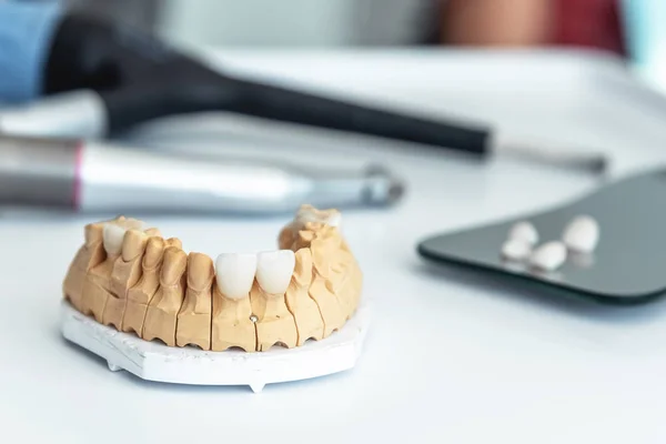 Diş laboratuvarında kaplama, Dental implantlar ve kron imalatı.