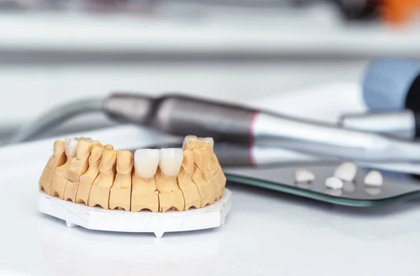 Artificial jaw with dental veneers and crowns in the office at the dentist.