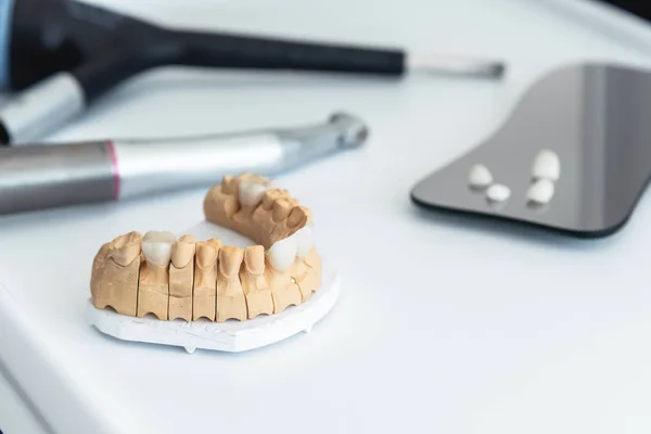 Mandíbula artificial con carillas dentales en el consultorio del dentista . —  Fotos de Stock