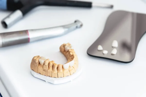 Artificial jaw with dental veneers and crowns in the dental laboratory.