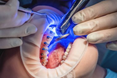 Dişçi doktor diş teli takıyor, ağzını kapatıyor. Sağlık ve diş tedavisi kavramı