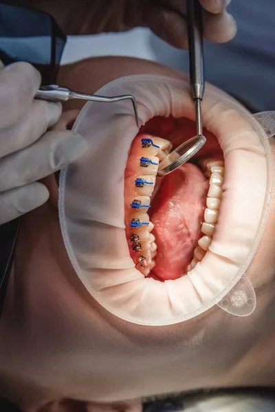 Dentist doctor installs braces system on teeth, close-up of open mouth. Health care and dental treatment concept