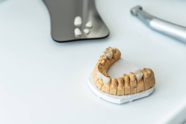 Artificial jaw with veneers and crowns, on the work table in the dental laboratory. Dentistry and treatment concept