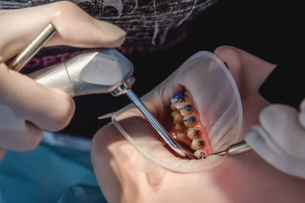 Dentista médico instala el sistema de frenos en los dientes, primer plano de la boca abierta. Concepto de atención médica y tratamiento dental — Foto de Stock