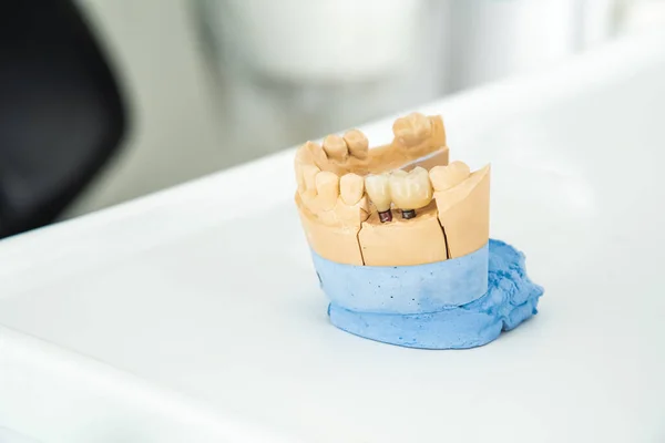 Ein künstlicher Kiefer mit einer Keramikkrone auf Implantaten steht auf einem Tisch in einer Arztpraxis. Zahnheilkunde und Behandlungskonzept — Stockfoto