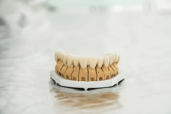 Artificial jaw with veneers and crowns, stands on a silver surface. Dentistry and treatment concept