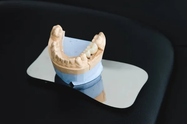 An artificial jaw with a ceramic crown on implants, stands on a surgical glass in a stolmatologic office. Dentistry and treatment concept — Stock Photo, Image