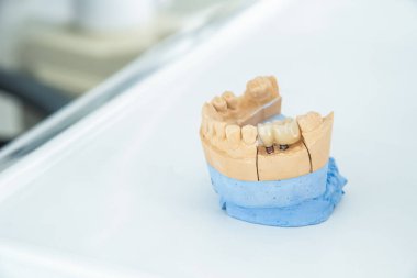Silikonların üzerine seramik taç takılmış yapay bir çene stolmatoloji ofisinde cerrahi bir camın üzerinde duruyor. Diş sağlığı ve tedavi kavramı