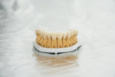 The artificial jaw with crowns rests on a silver surface in a stolmatologic office. Dentistry and treatment concept