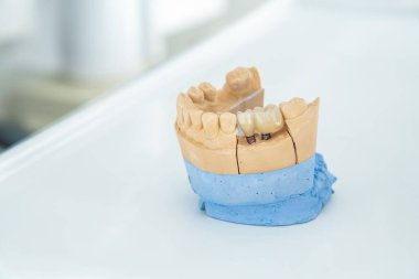İmplantlara seramik taç takmış yapay bir çene, bir tıp bürosundaki masanın üzerinde duruyor. Diş sağlığı ve tedavi kavramı