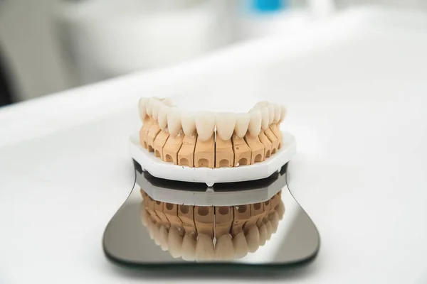 Una mandíbula artificial con carillas y coronas, se encuentra sobre un vaso quirúrgico en una oficina estolmatológica. Concepto de odontología y tratamiento —  Fotos de Stock