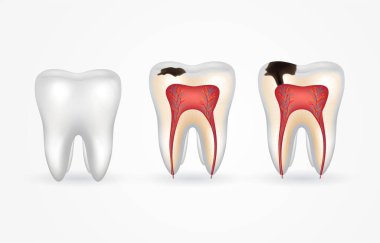 Diş çürüğü ve sağlıklı diş. Yüzeysel çürük; derin çürük; Mine ve dentin bozmak; periodontitis. 3D gerçekçi diş içte ve dışta.