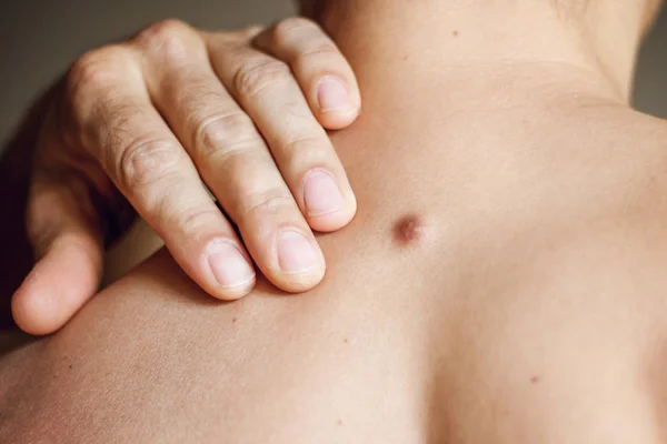 Fibroma sulla schiena maschile, dettagli, primo piano — Foto Stock