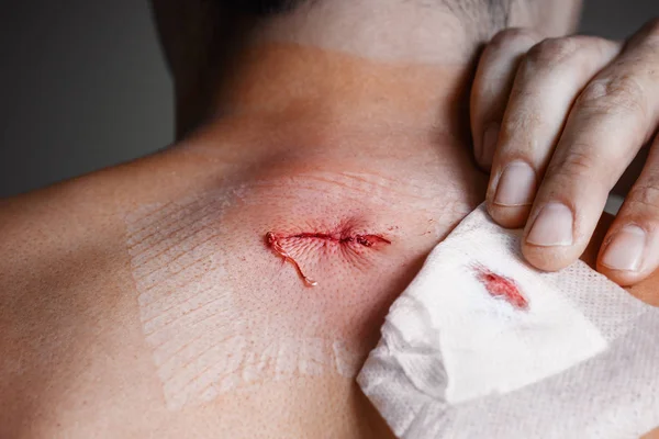 Τραυματισμένος χειρουργός, τραυματισμός στην πλάτη ενός άντρα, φρέσκια ουλή, κοντινό, γκρι φόντο — Φωτογραφία Αρχείου