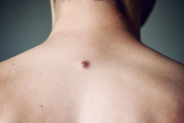 Fibrome sur le dos masculin, détails, gros plan — Photo