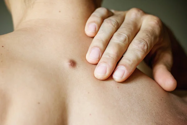 Fibroma sulla schiena maschile, dettagli, primo piano — Foto Stock