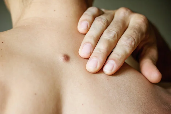 Fibroma on the male back, details, close-up — Stock Photo, Image