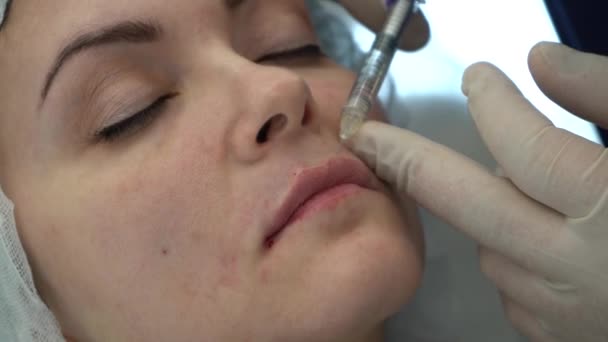 The doctor in white gloves makes a correction of the shape of the contour of the lips — Stock video