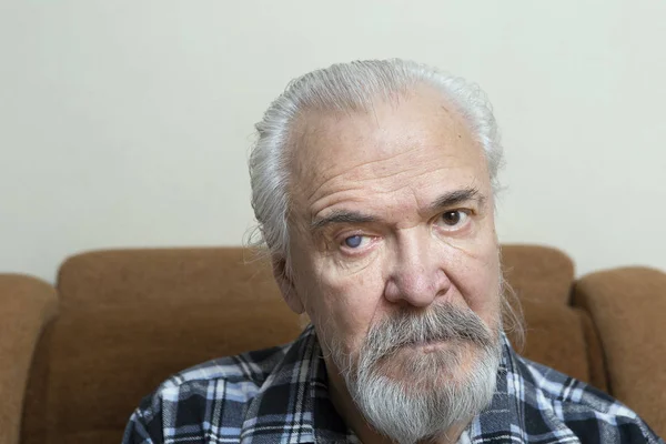 患有白内障和青光眼的老人右眼有刺 — 图库照片