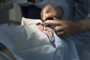 Lazer ameliyatı için vizyon düzeltme ve katarakt kaldırma