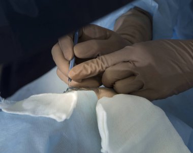Lazer ameliyatı için vizyon düzeltme ve katarakt kaldırma