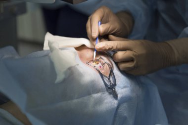 Lazer ameliyatı için vizyon düzeltme ve katarakt kaldırma