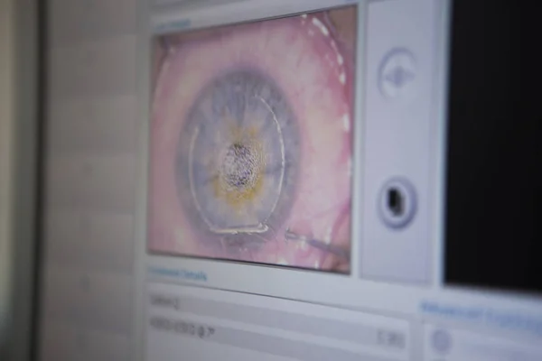 Laser surgery for vision correction and cataract removal