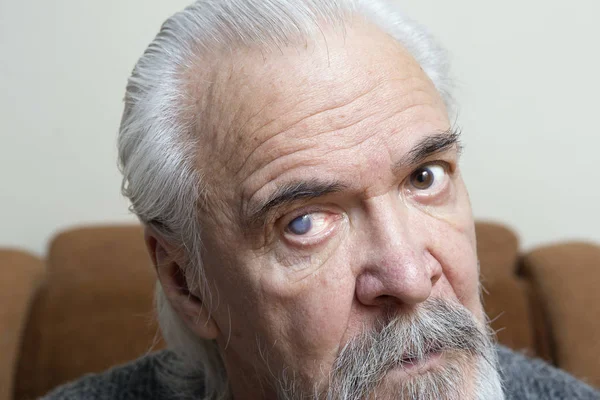Oude Eenzame Man Ziek Cataract Stockfoto