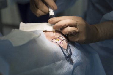 Lazer ameliyatı için vizyon düzeltme ve katarakt kaldırma