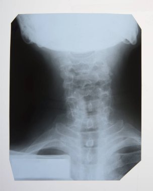 X-ışını kifoz ve servikal osteochondrosis yaşlı bir kişinin omurga