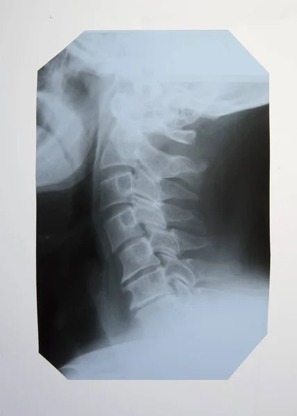 Raio Coluna Vertebral Idoso Com Cifose Osteocondrose Cervical — Fotografia de Stock