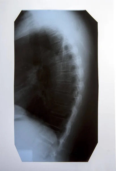 Radiografía Columna Vertebral Una Persona Mayor Con Cifosis Osteocondrosis Cervical — Foto de Stock