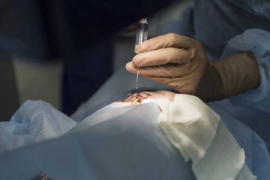 Lazer cerrahisi vizyon düzeltme