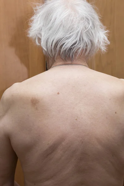 Skin nevus of the back — Stock Photo, Image
