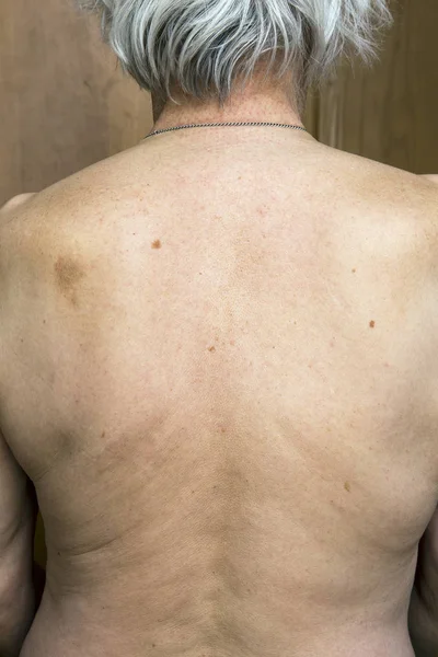 Skin nevus of the back — Stock Photo, Image
